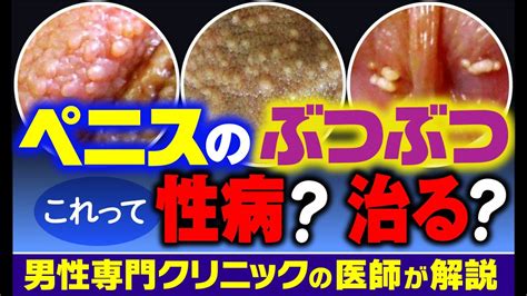 ちんこのブツブツは何？ペニスのカリ首や陰茎の白いぶつぶつの。